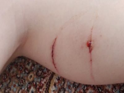 حمله سگ هار به پسر ۱۲ ساله در مرکز شهر تبریز